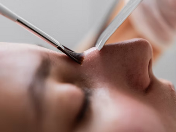 Understanding Blackheads: Causes and Treatments